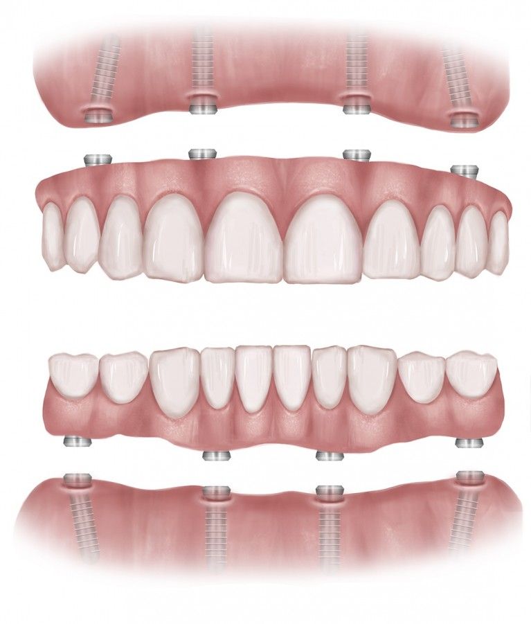 Fully guaranteed Dental Implants Cost Per Tooth Uk