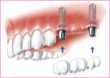 Teeth Implants Gravesend Kent