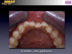 Inman Aligner before kent