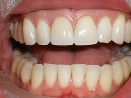 Dental Bonding - Before and After at Preventive Dentistry Braddon