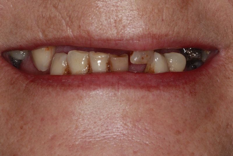 Before And After Image Dental Implants at Parrock Dental In Gravesend Kent