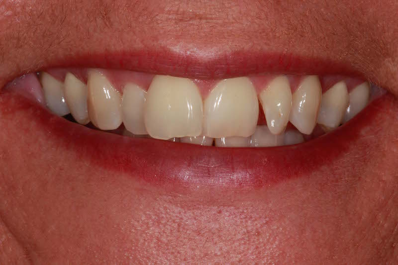 Crowded Top Teeth Fixed with Braces | Before and After Photos