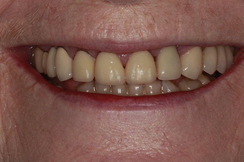 dental implants kent uk