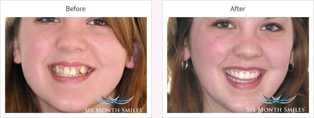 Six month smile before and after case 10