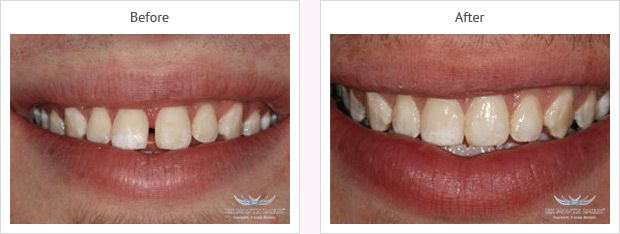 Six month smile before and after case 2 Kent