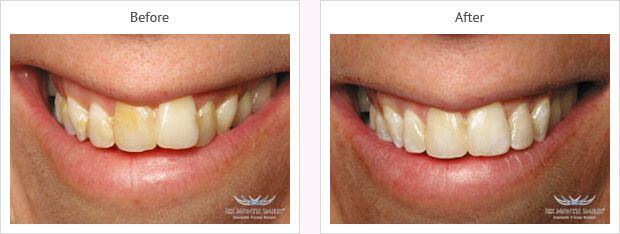 Six month smile before and after case 6
