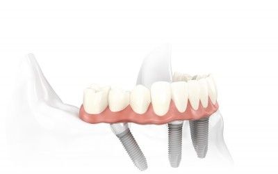 Are Dental Implants the answer to your dental problems?