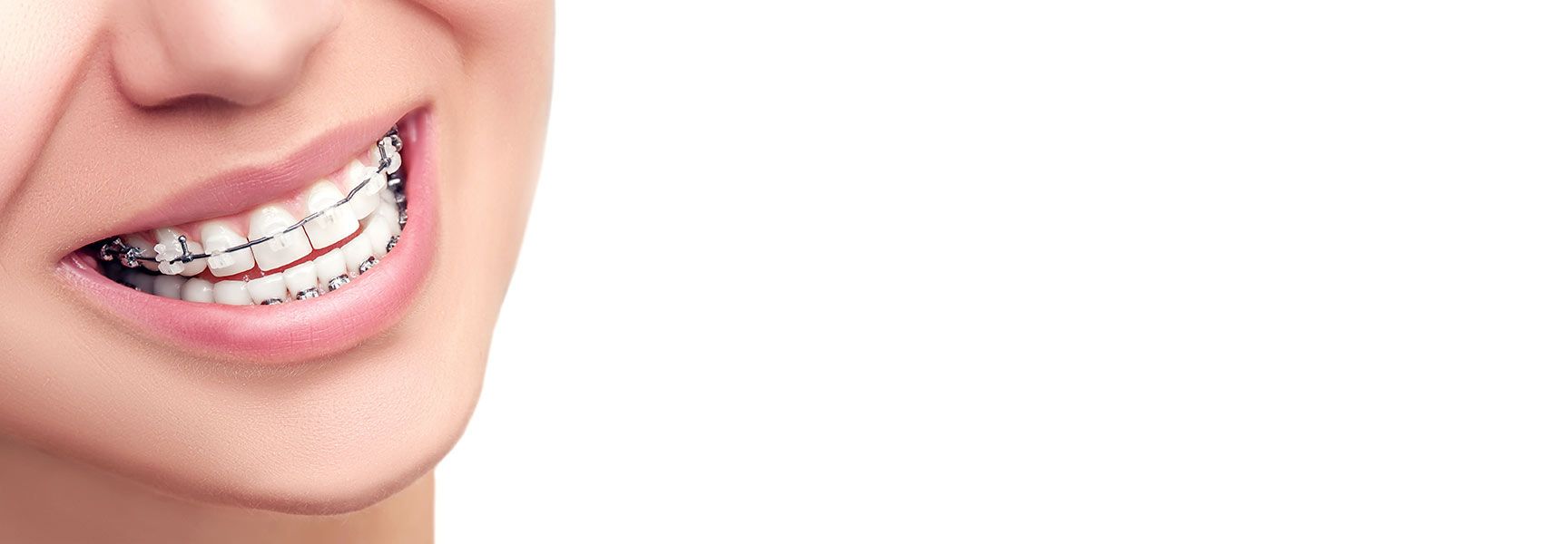 bracesad1 Parrock Dental & Implant Centres