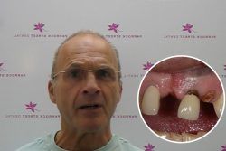 Roger – Replaced multiple teeth