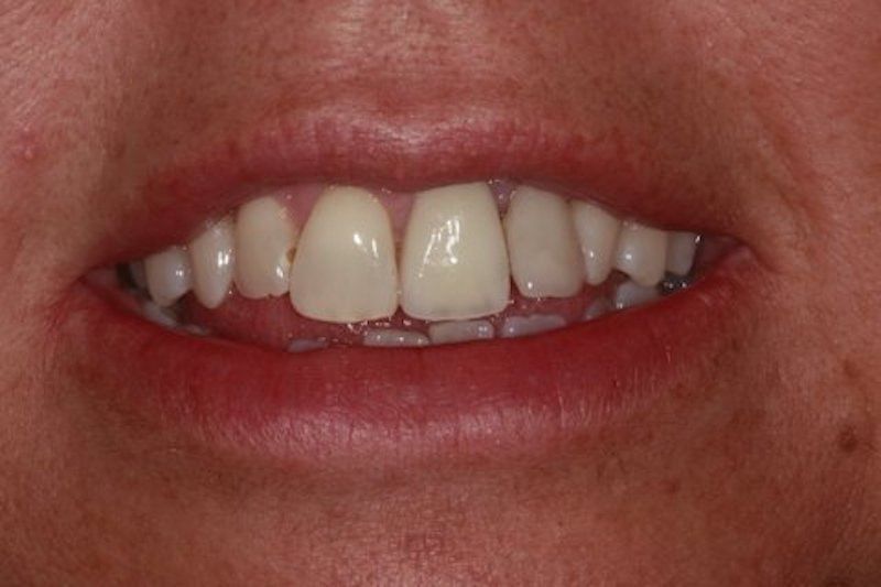 Before And After Image Dental Implants at Parrock Dental In Gravesend Kent