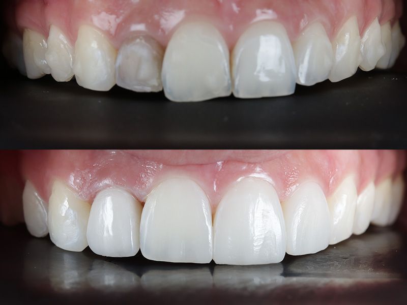 bonding-teeth-kent