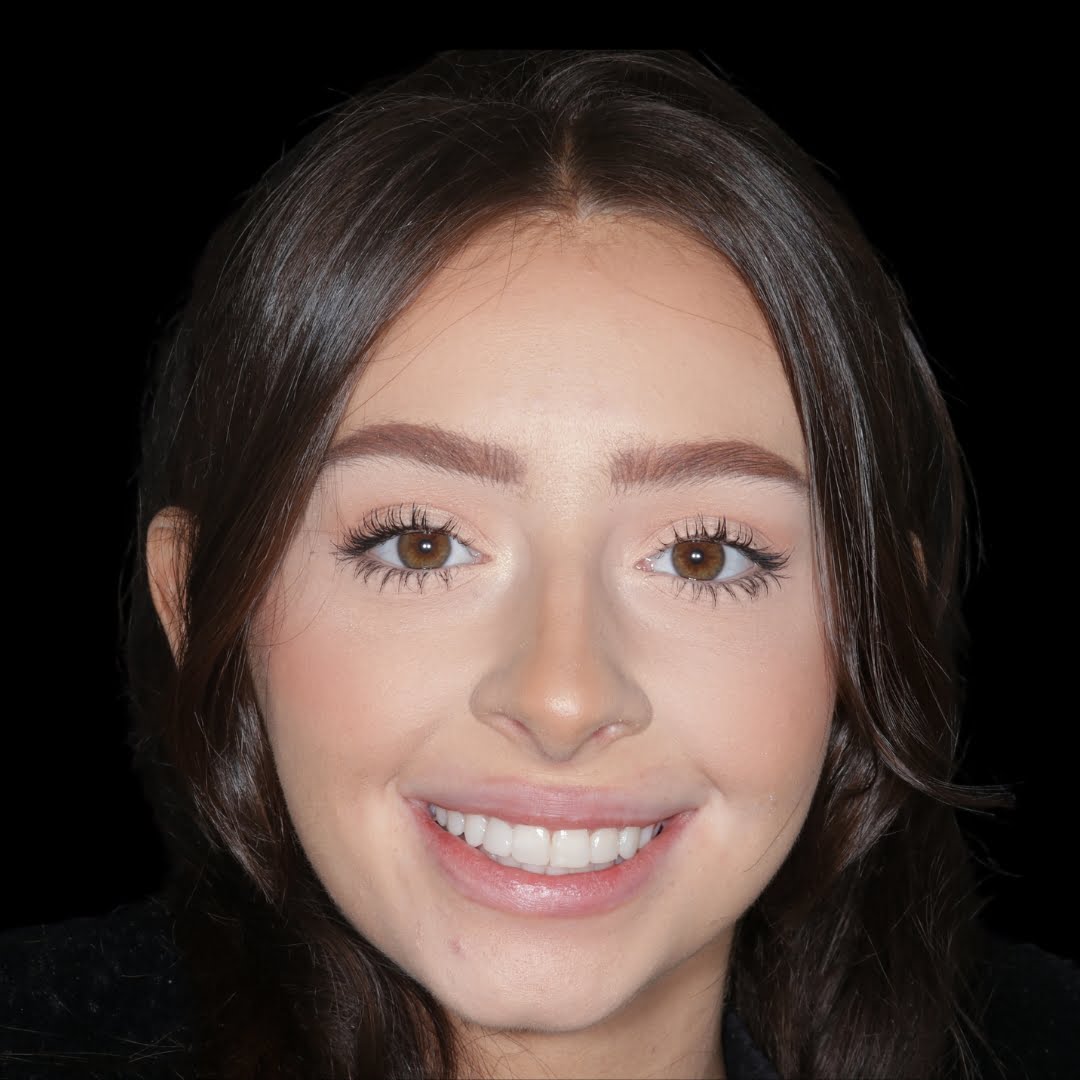 rebecca wood composite bonding